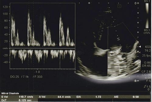 心臓超音波検査